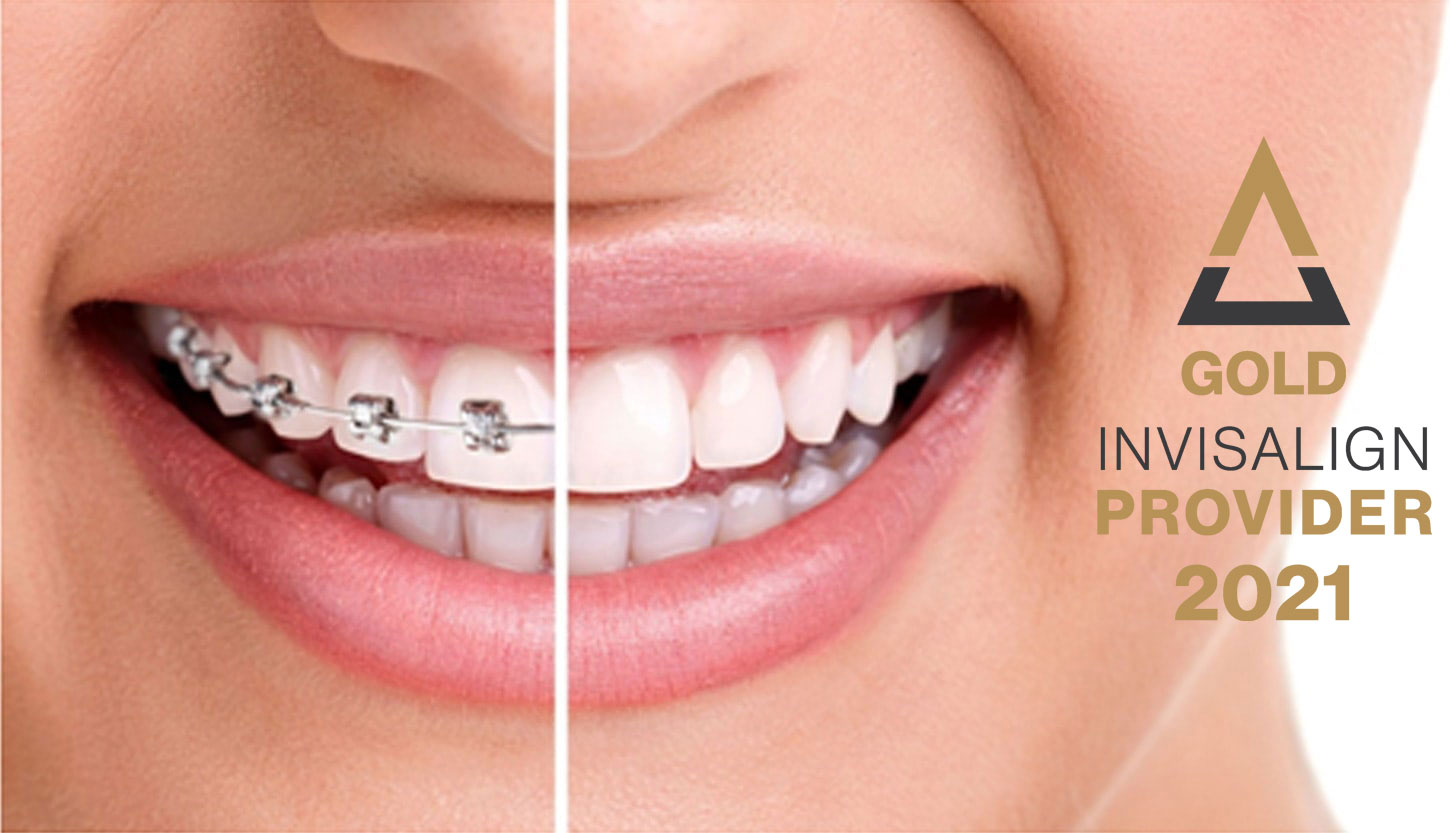 invisalign_a