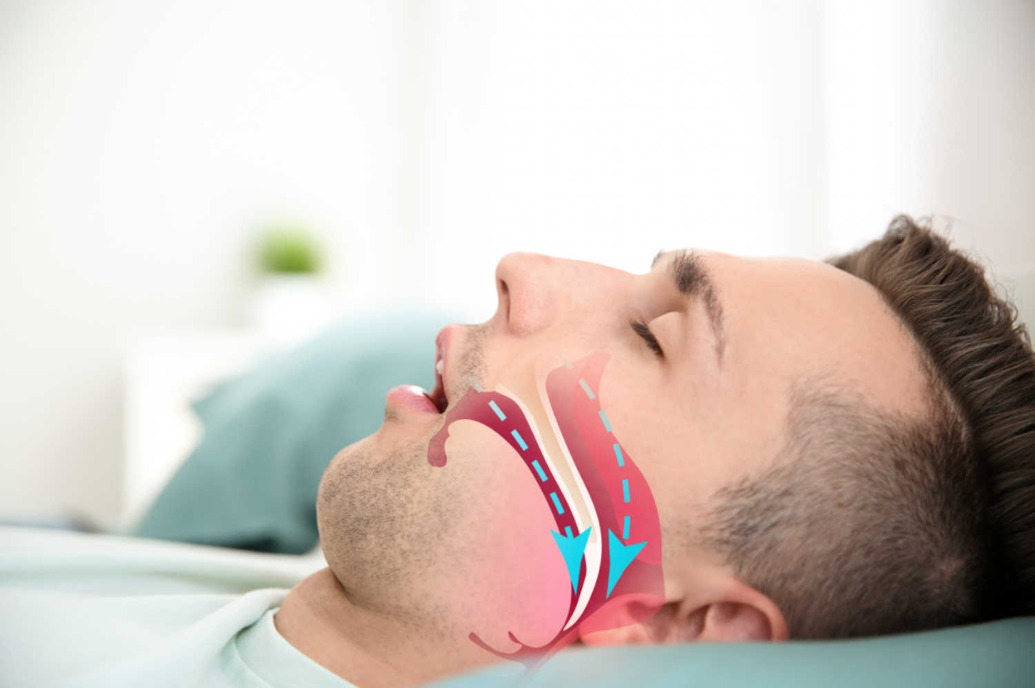 sleep-apnea-oakville